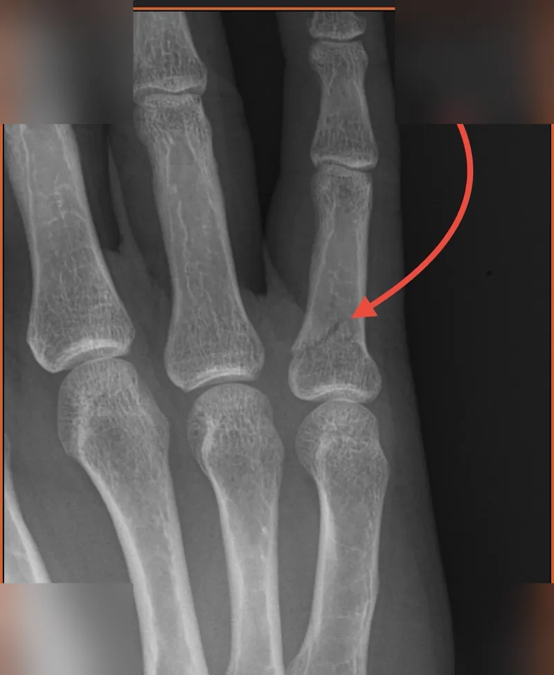 X-ray showing a hairline fracture on the pinky finger
