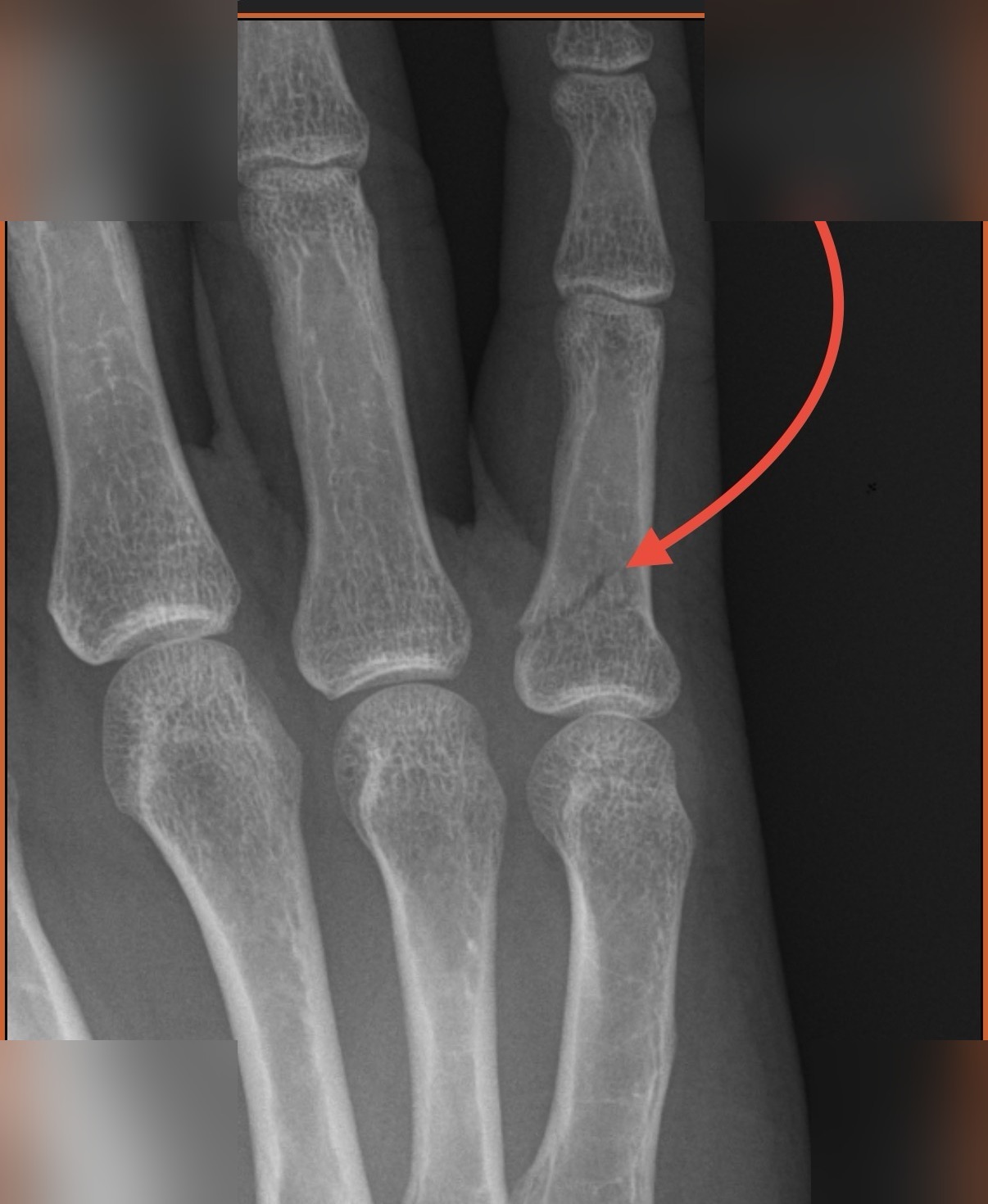 X-ray showing a hairline fracture on the pinky finger